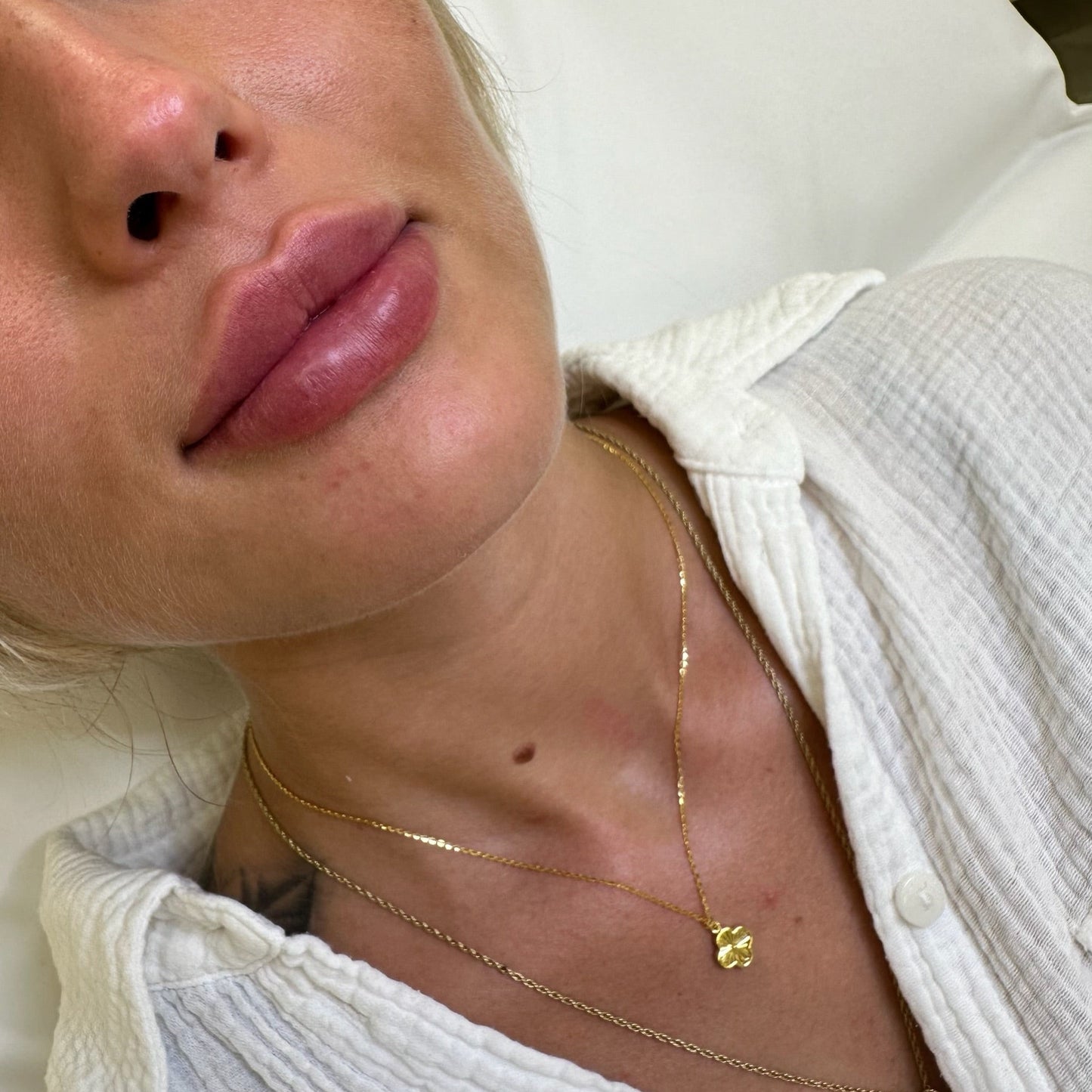 Basic Lip Class - Technique and introduction to lip injections 08.08.25